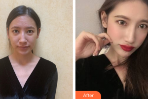 廣州愈生醫(yī)院美容整形中心李寅整形價(jià)格表附肋軟骨隆鼻案例展示