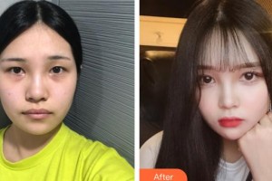上海新健威醫(yī)療美容門(mén)診部錢(qián)成寶整形價(jià)格表附頜面整形案例展示