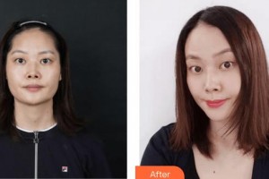 上?？祳W醫(yī)療美容醫(yī)院胡康容整形價(jià)格表附光子嫩膚案例展示