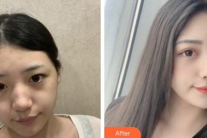 上海復(fù)旦大學(xué)附屬中山醫(yī)院整形外科施越冬整形價(jià)格表附激光祛斑案例展示