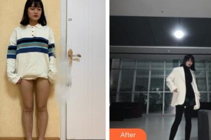 上海復(fù)麗醫(yī)療美容門診部張家偉整形價(jià)格表附吸脂瘦大腿案例展示