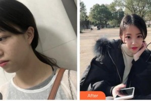 上海復(fù)麗醫(yī)療美容門診部莊賀婷整形價(jià)格表附超激光美膚激光案例展示