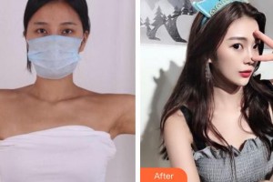 上海光博士醫(yī)療美容門診部李思住院醫(yī)師整形價(jià)格表附手臂吸脂案例展示