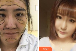 上海復(fù)麗醫(yī)療美容門診部鄭佳瑋整形價(jià)格表附自體脂肪案例展示