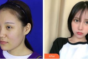 上海俏佳人整形外科門診部田苗苗整形價(jià)格表附鼻部手術(shù) 面部吸脂案例展示