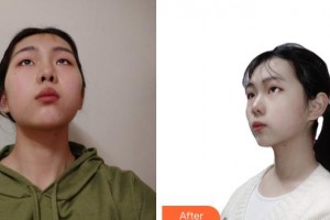 上海凱渥醫(yī)療美容門診部許心蕾整形價(jià)格表附光子嫩膚案例展示