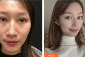 上海WA臻景醫(yī)療美容門診部GeorgiaLee整形價(jià)格表附微針祛痘案例展示