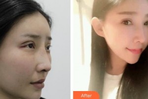 上海WA臻景醫(yī)療美容門診部KimSam整形價(jià)格表附雙眼皮修復(fù)案例展示