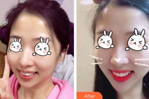 上海瑞東醫(yī)院美容皮膚科劉麗琳整形價(jià)格表附無針?biāo)獍咐故?>
</a>
<h3 class=