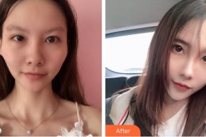 上海許強(qiáng)徒手整形診所許強(qiáng)整形價(jià)格表附顴骨顴弓案例展示