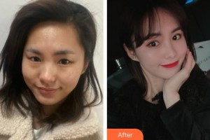 上海美立方整形醫(yī)院滕彥整形價(jià)格表附星眉眼部手術(shù)6項(xiàng)升級(jí)版案例展示