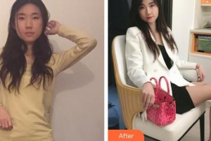 桂林華美醫(yī)療美容門(mén)診部趙麗紅整形價(jià)格表附玻尿酸導(dǎo)入精華案例展示