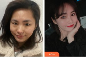 貴陽(yáng)醫(yī)學(xué)院附屬醫(yī)院燒傷整形外科孔豫蘇整形價(jià)格表附眼部綜合案例展示