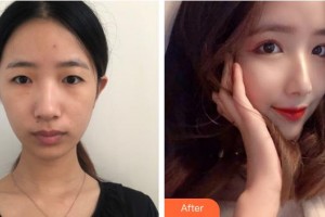 上海希瑪瑞視眼科醫(yī)院李俊整形價(jià)格表附眼部整形案例展示
