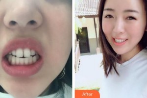 上海維樂口腔門診部沈華整形價(jià)格表附門牙擁擠、齙牙案例展示