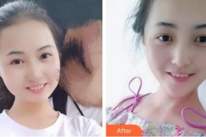 上海華美醫(yī)療美容醫(yī)院黃嵩整形價(jià)格表附半隱形單晶案例展示