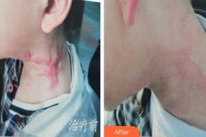 上海瑞金醫(yī)院舟山分院燒傷整形美容科黃曉琴整形價格表附燙傷疤痕修復(fù)案例展示