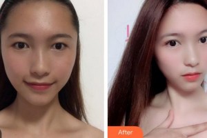 上海麗質(zhì)整形美容醫(yī)院陳新平整形價格表附洛麗塔眼部手術(shù)案例展示