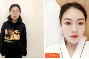 上海愛爾麗醫(yī)療美容門診部陳俊穆整形價格表附抗衰產(chǎn)品微針案例展示