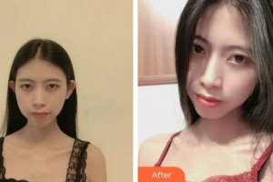 上海愛(ài)爾麗醫(yī)療美容門(mén)診部蘇愉婕整形價(jià)格表附微針美白嫩膚縮小毛孔案例展示