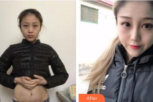 上海麗鉑醫(yī)療美容門(mén)診部丁奕如整形價(jià)格表附妊娠紋案例展示