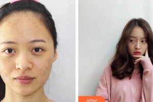 上海天美醫(yī)療美容醫(yī)院秦易見(jiàn)整形價(jià)格表附面部吸脂瘦臉案例展示