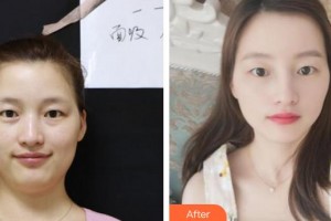 上海天美醫(yī)療美容醫(yī)院安迪整形價(jià)格表附面部光纖吸脂案例展示