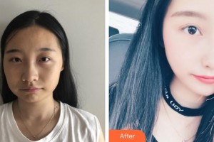 上海瑰康醫(yī)療美容門(mén)診部李南整形價(jià)格表附磨骨案例展示