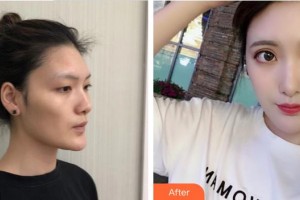 上海韓鏡醫(yī)療美容醫(yī)院趙越整形價(jià)格表附自體脂肪填充額頭案例展示