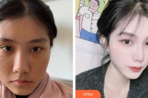 上海安平醫(yī)院美容科曾海波整形價(jià)格表附美白嫩膚案例展示