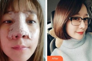 上海醫(yī)顏醫(yī)療美容門診部李曙光整形價格表附鼻部手術案例展示