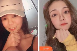 上海普瑞眼科醫(yī)院周靜整形價格表附全切雙眼皮案例展示