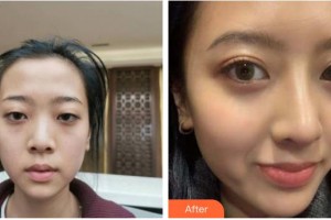 成都藝星醫(yī)療美容醫(yī)院蔡靈整形價格表附半肋鼻部手術案例展示