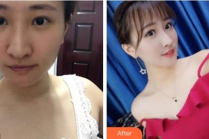 成都儀美醫(yī)療美容門(mén)診部周儀整形價(jià)格表附鼻部手術(shù)案例展示