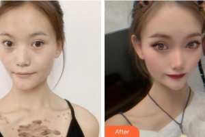 成都美容整形醫(yī)院瞿維鈞整形價(jià)格表附疤痕疙瘩案例展示