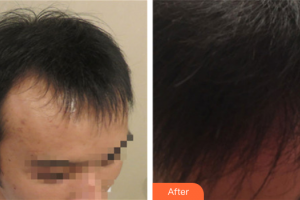 廣州新發(fā)現(xiàn)植發(fā)連鎖機構(gòu)吳安利整形價格表附種植發(fā)際線案例展示