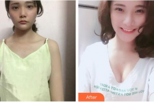 成都美容整形醫(yī)院賴明忠整形價格表附復(fù)合隆胸案例展示