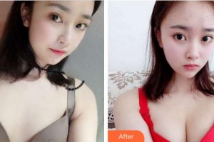 成都醫(yī)美整形美容醫(yī)院王顯榮整形價格表附濃縮豐胸真實案例展示