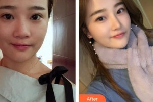 成都漢密爾頓美容醫(yī)院洪邦泰教授整形價格表附鼻部綜合案例展示