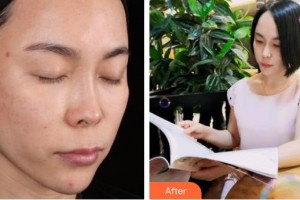 成都少城醫(yī)院醫(yī)療美容科朱天申整形價格表附多方面部埋線提升案例展示