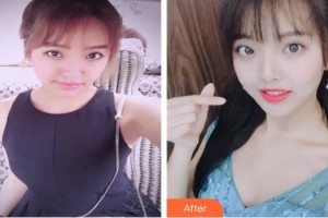 成都少城醫(yī)院醫(yī)療美容科趙世欽整形價格表附假體下巴案例展示