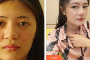 成都美雅娜醫(yī)療美容門診部廖連平整形價格表附鼻部整形案例展示
