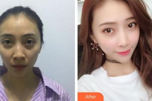成都艾美薇醫(yī)療美容門診部汪國義整形價格表附自體脂肪填充案例展示