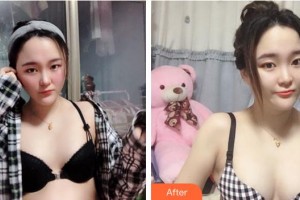 成都藝星醫(yī)療美容醫(yī)院周鵬起整形價格表附濃縮豐胸真實案例展示