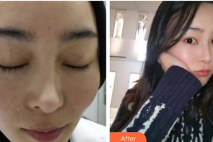 成都艾尚醫(yī)學美容門診部張桂林整形價格表附祛斑案例展示