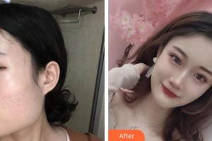 成都艾尚醫(yī)學美容門診部高亮整形價格表附下頜角整形案例展示