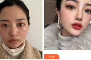 成都風尚格致醫(yī)學美容整形醫(yī)院王曉斌整形價格表附顴骨+下頜角案例展示