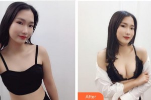 成都華顏醫(yī)療美容門診部王平整形價格表附濃縮豐胸真實案例展示