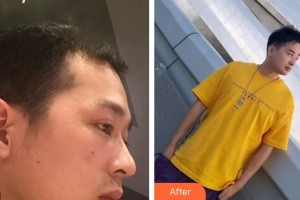 成都風尚格致醫(yī)學美容整形醫(yī)院余正倫副教授 整形價格表附發(fā)際線案例展示