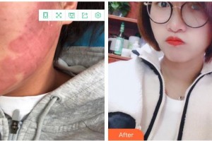成都美極醫(yī)療美容門診部黃華整形價格表附點陣祛痘坑痘印案例展示